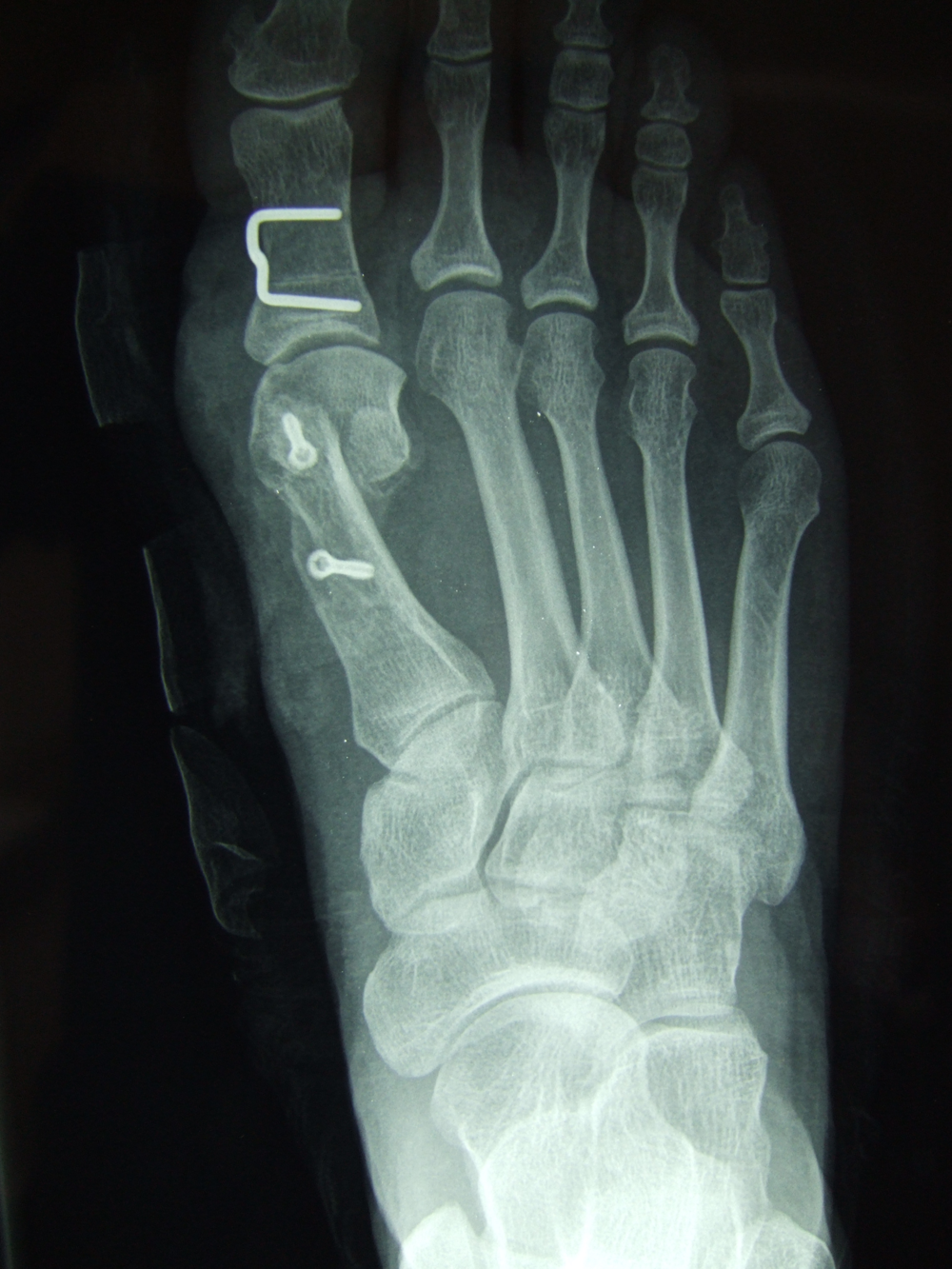 What is the common name for a hallux valgus?